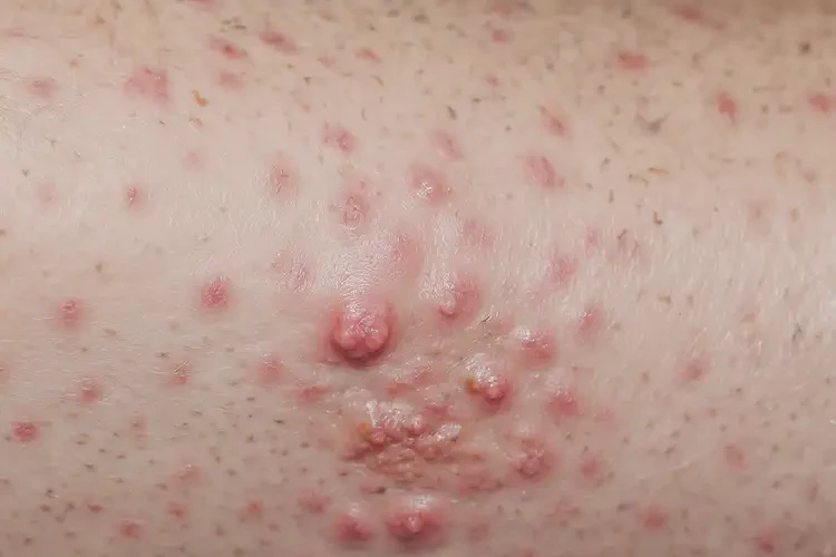 大學生小腿經(jīng)常起濕疹不管它會自己痊愈嗎(圖4)