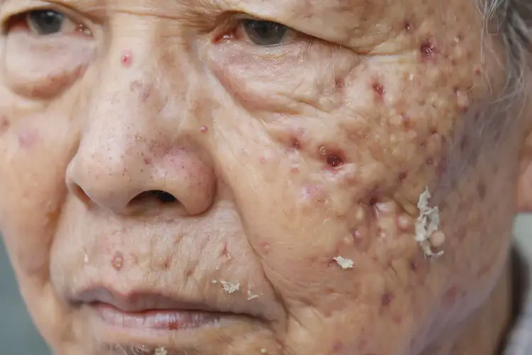 老年人面部經(jīng)常起濕疹不管它會自己自愈嗎(圖4)