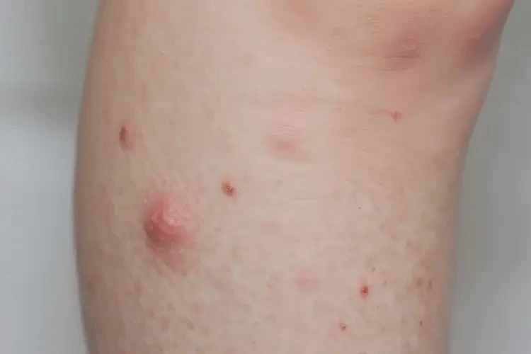青少年小腿上偶爾起濕疹不管它會自己自愈嗎(圖4)