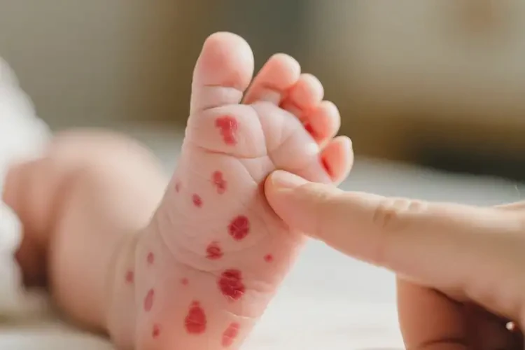 嬰兒腳上偶爾起濕疹能徹底自愈嗎(圖1)