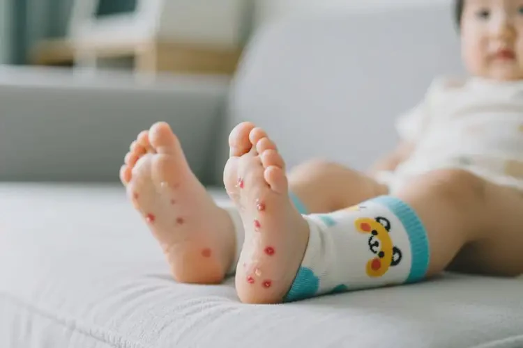 小孩腳上經(jīng)常長(zhǎng)濕疹可不可以徹底自愈(圖1)
