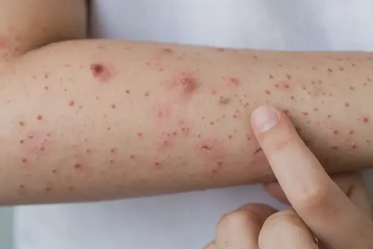 青少年手臂容易起濕疹不管它會自己自愈嗎(圖4)
