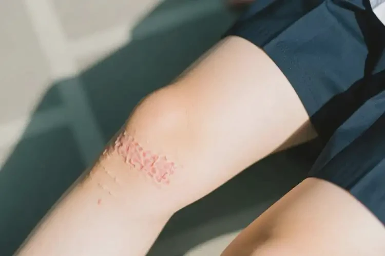 中學生大腿出現(xiàn)濕疹能靠自己自愈嗎(圖1)