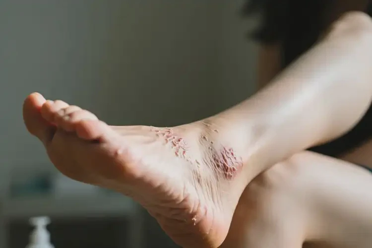 女人腳上出濕疹不管它會自己痊愈嗎(圖3)