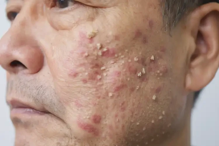 男性屁股起濕疹不管它會自己好嗎(圖4)