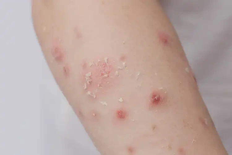 兒童手臂上出濕疹能徹底自愈嗎(圖4)