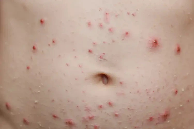 少兒肚子容易長濕疹不管它會自己自愈嗎(圖4)