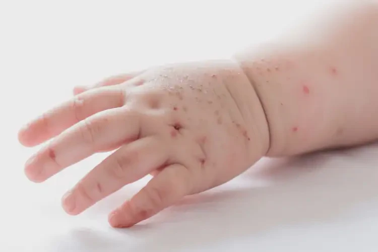 寶寶手上起濕疹不管它會(huì)自己自愈嗎(圖4)