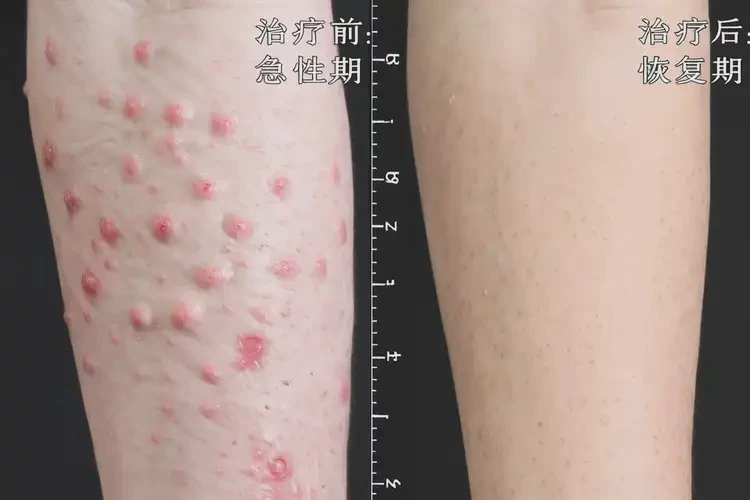 男性面部經(jīng)常起濕疹可不可以徹底自愈(圖1)