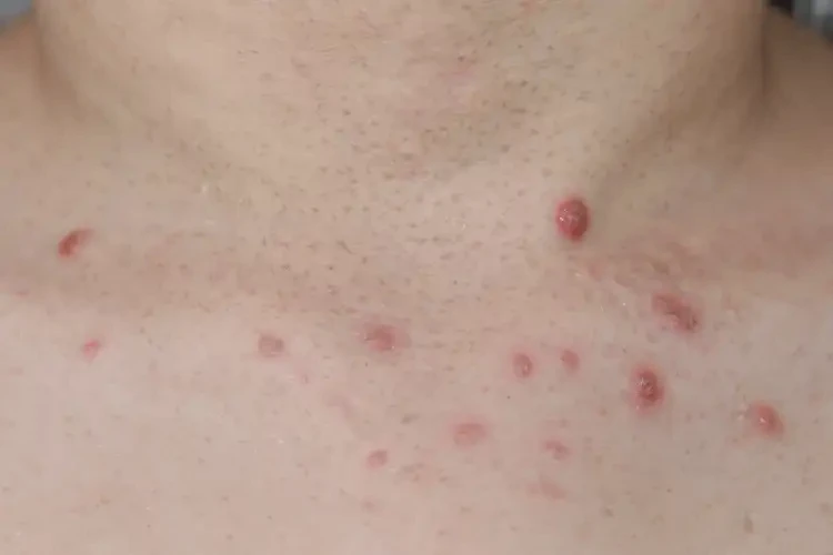 小兒脖子上長濕疹可不可以徹底自愈(圖4)