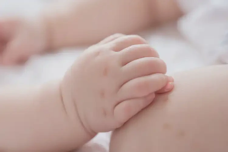 嬰兒手上偶爾長(zhǎng)濕疹能夠徹底治愈嗎(圖4)