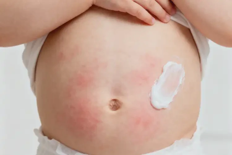 孩子肚子上偶爾起濕疹能徹底自愈嗎(圖3)
