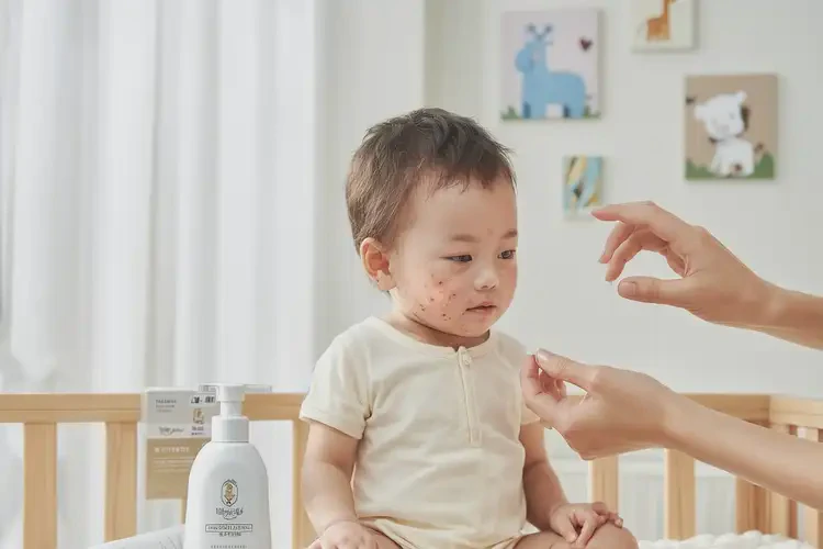 幼兒面部經(jīng)常起濕疹不管它會(huì)自己痊愈嗎(圖3)
