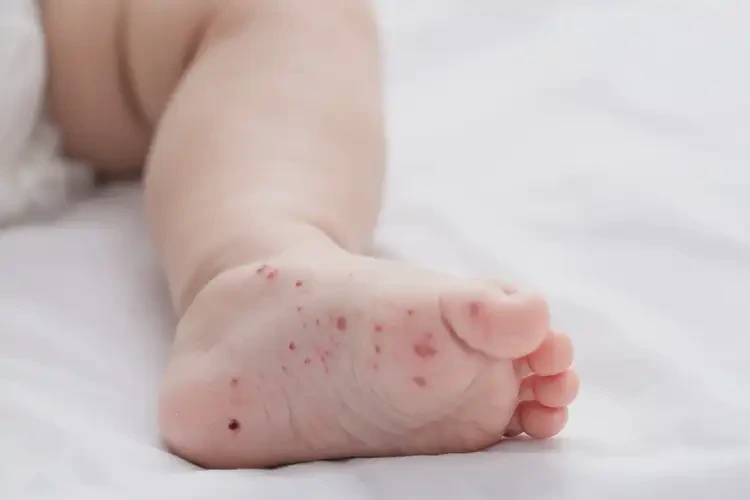 寶寶腳上偶爾長(zhǎng)濕疹不管它會(huì)自己痊愈嗎(圖4)