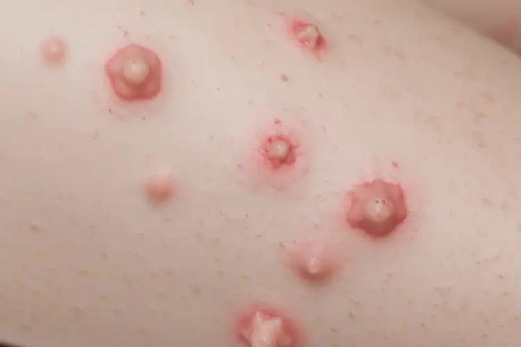 中學(xué)生小腿經(jīng)常長(zhǎng)濕疹不管它會(huì)自己自愈嗎(圖4)