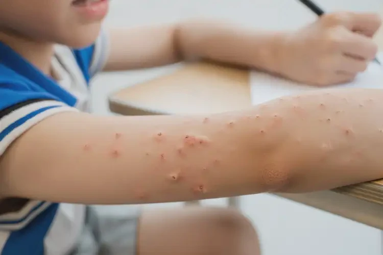 小學(xué)生四肢偶爾長濕疹可不可以徹底自愈(圖4)