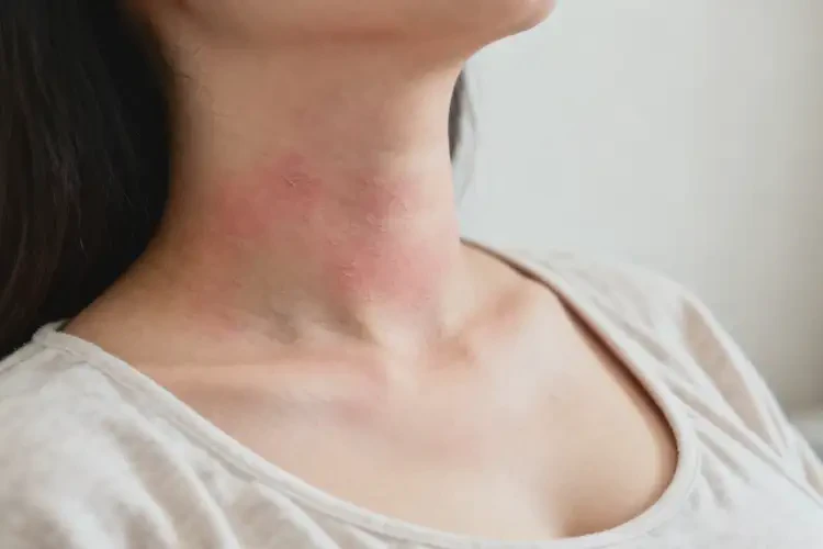 孕婦脖子長濕疹可以徹底自愈嗎(圖2)