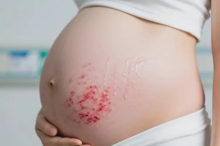 孕婦肚子經(jīng)常長(zhǎng)濕疹可不可以徹底自愈(圖1)