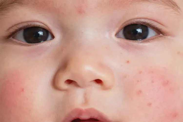 嬰幼兒面部長(zhǎng)濕疹能徹底自愈嗎(圖2)