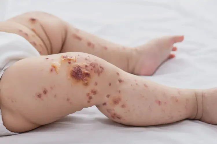 寶寶大腿上長(zhǎng)濕疹可不可以徹底自愈(圖2)