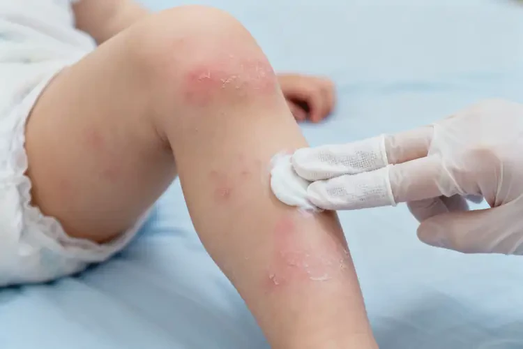 小孩大腿容易長濕疹可不可以徹底自愈(圖3)