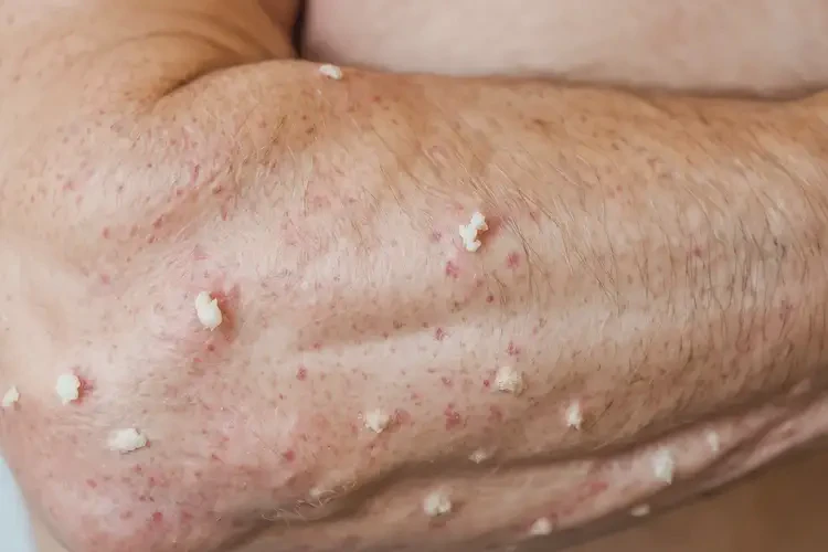 男生身上偶爾長(zhǎng)濕疹不管它會(huì)自己好嗎(圖4)