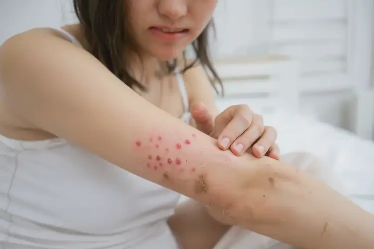 產(chǎn)婦手臂上容易起濕疹可不可以徹底自愈(圖4)