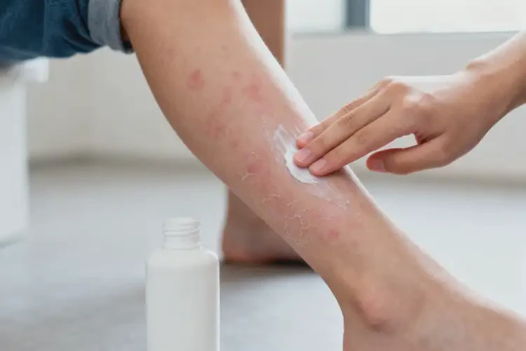 青少年小腿上偶爾起濕疹能徹底自愈嗎(圖4)