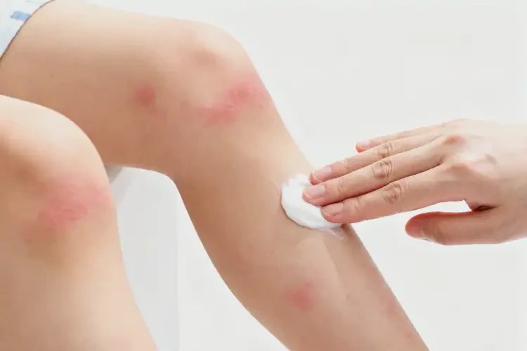 孩子大腿上起濕疹不管它會(huì)自己痊愈嗎(圖4)