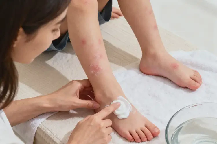 兒童腳上出現(xiàn)濕疹不管它會(huì)自己自愈嗎(圖2)