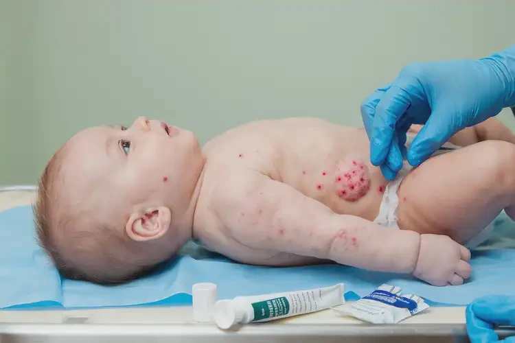 寶寶大腿上容易長濕疹能夠徹底治愈嗎(圖4)