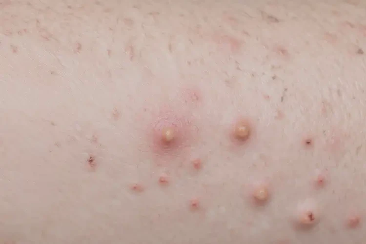 大学生脚上出湿疹不管它会自己痊愈吗(图4)