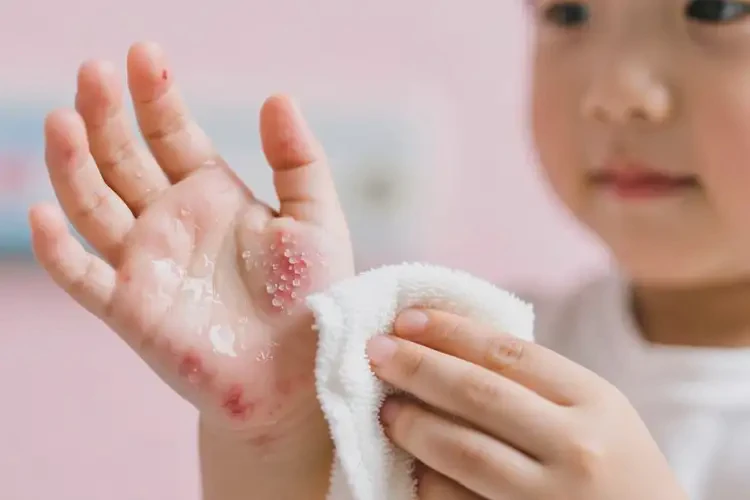 孩子手上出濕疹能夠徹底治愈嗎(圖3)