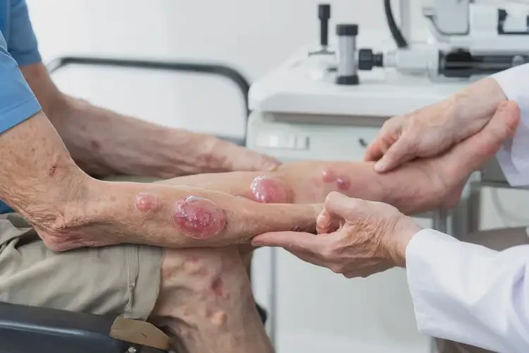 老年人四肢有濕疹不管它會自己自愈嗎(圖4)