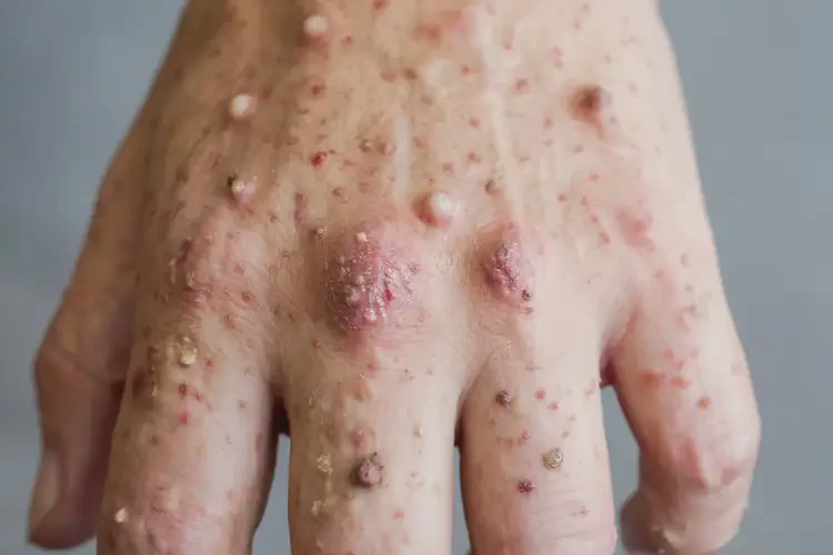 男生手上出湿疹能靠自己自愈吗(图4)