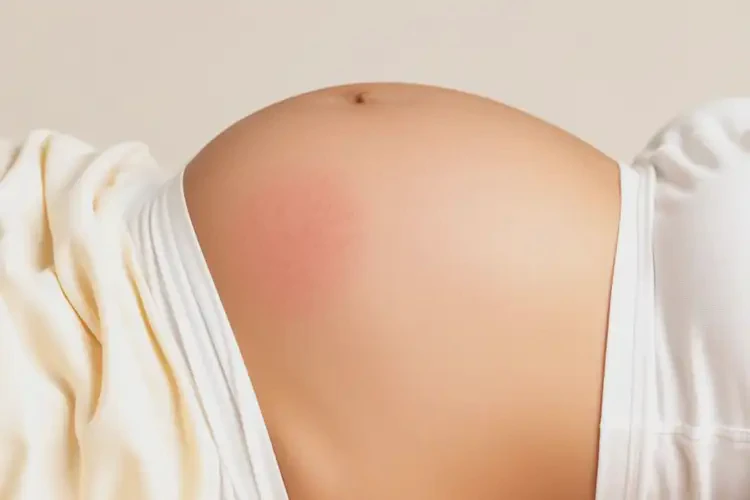 產(chǎn)婦屁股上長濕疹不管它會自己好嗎(圖2)