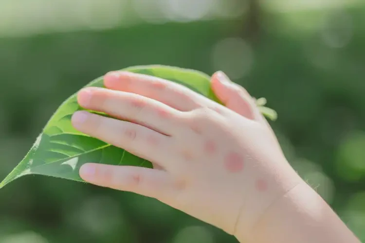 孩子手上偶爾起濕疹不管它會(huì)自己自愈嗎(圖1)