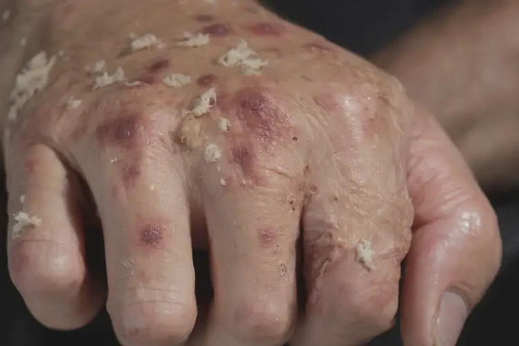 男性手上容易起濕疹能靠自己自愈嗎(圖4)