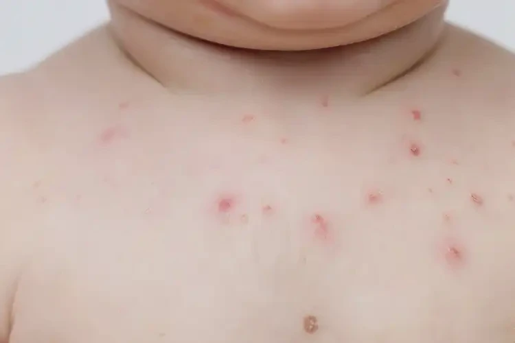 寶寶脖子起濕疹不管它會自己自愈嗎(圖4)