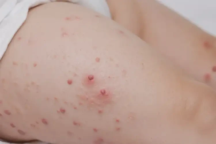 嬰幼兒大腿經(jīng)常起濕疹能夠徹底治愈嗎(圖4)