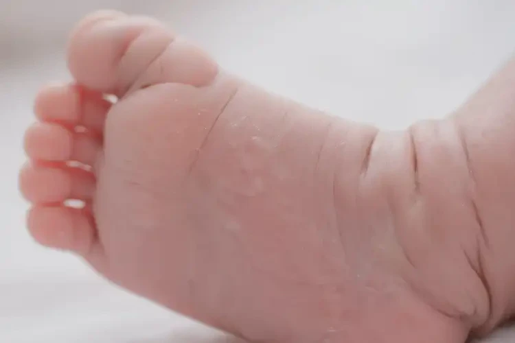 嬰兒小腿偶爾長濕疹能靠自己自愈嗎(圖4)