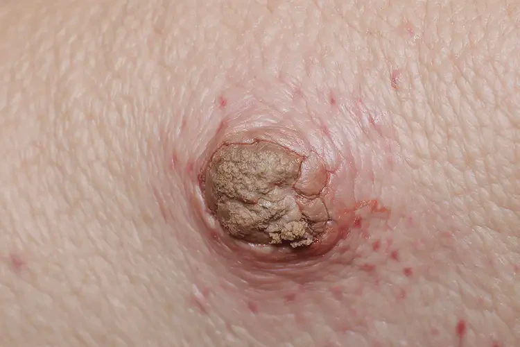 男生肚子長濕疹不管它會自己自愈嗎(圖3)