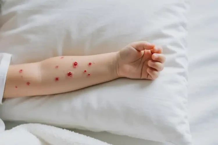 小學生手臂上起濕疹能不能徹底自愈(圖1)