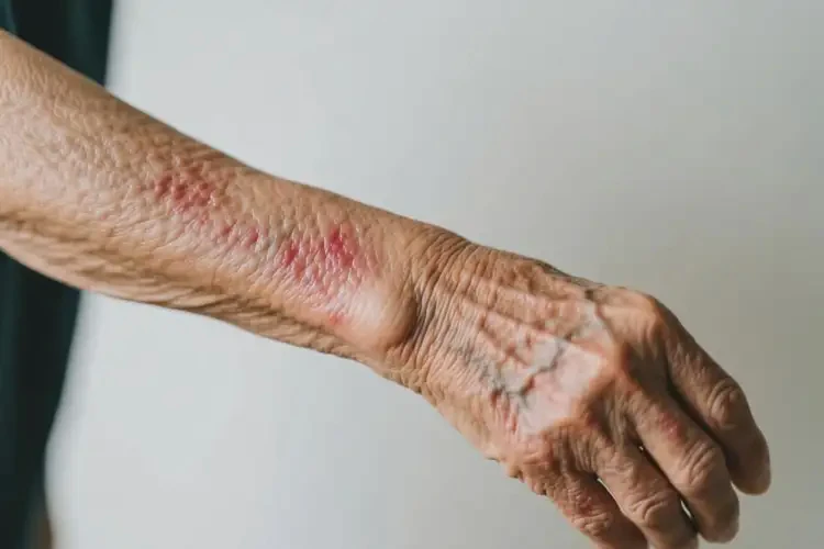 老人手臂上出現(xiàn)濕疹能靠自己自愈嗎(圖4)