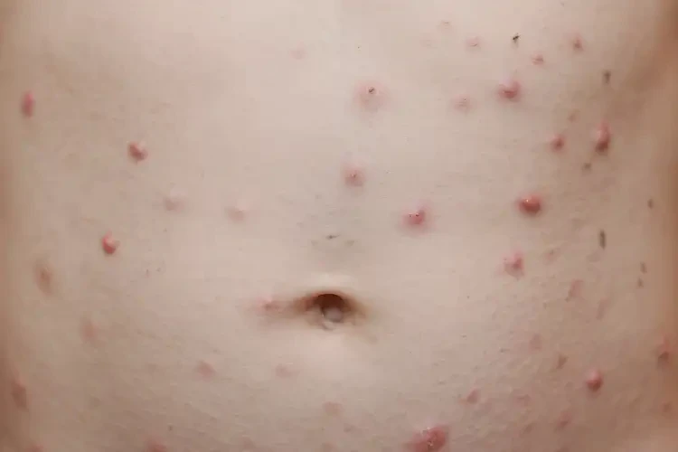 小孩肚子上有濕疹能徹底自愈嗎(圖4)