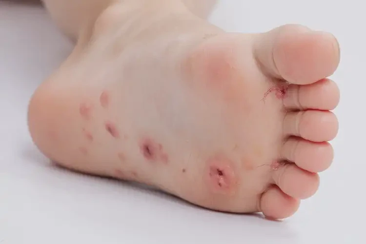 孩子腳上長濕疹能徹底自愈嗎(圖4)