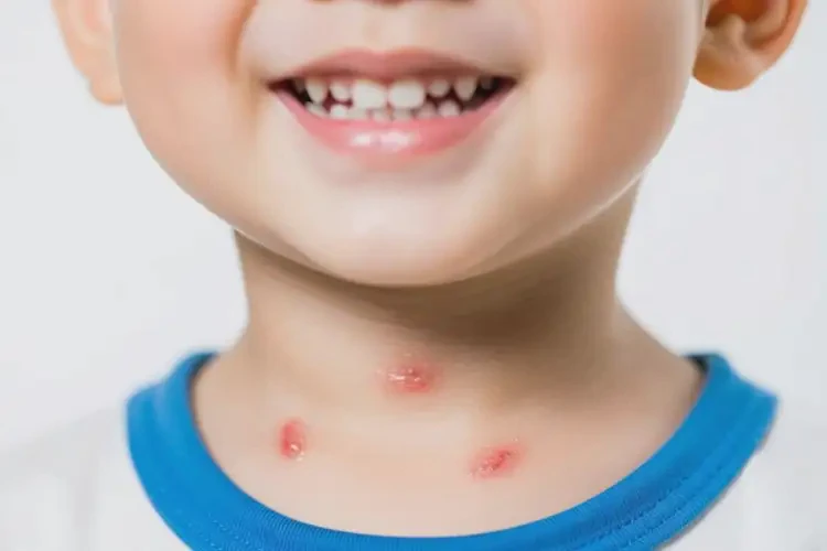 小孩脖子上偶尔起湿疹能彻底自愈吗(图1)