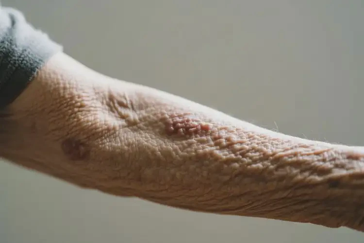 老年人手臂上出现湿疹能够彻底治愈吗(图1)