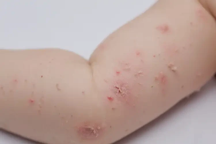 幼兒手臂上出現(xiàn)濕疹不管它會(huì)自己好嗎(圖4)