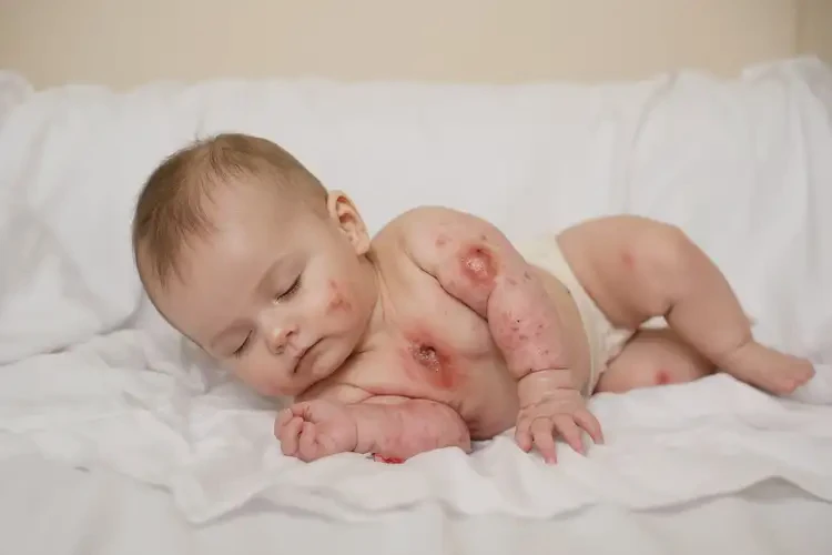 嬰兒脖子上有濕疹能徹底自愈嗎(圖1)